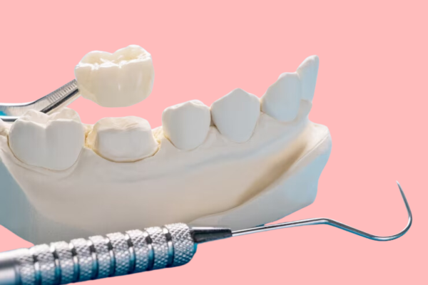 Dental Crown Treatment