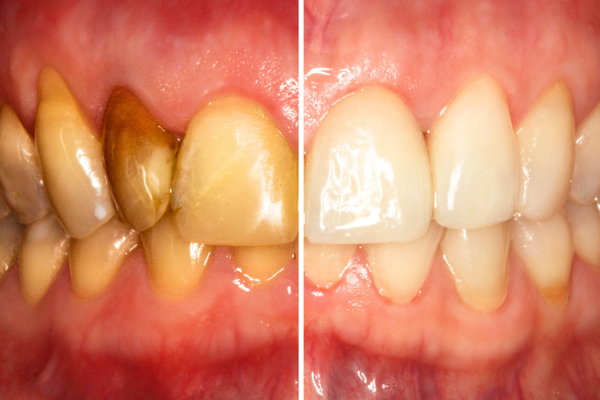 Gum Disease and Scaling